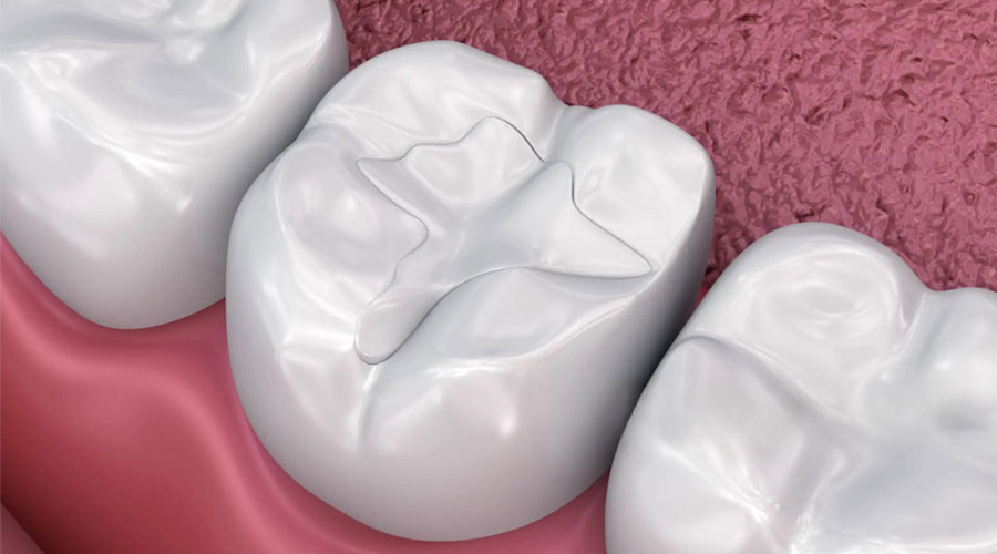 warm_smile_dental_tooth_colored_fillings